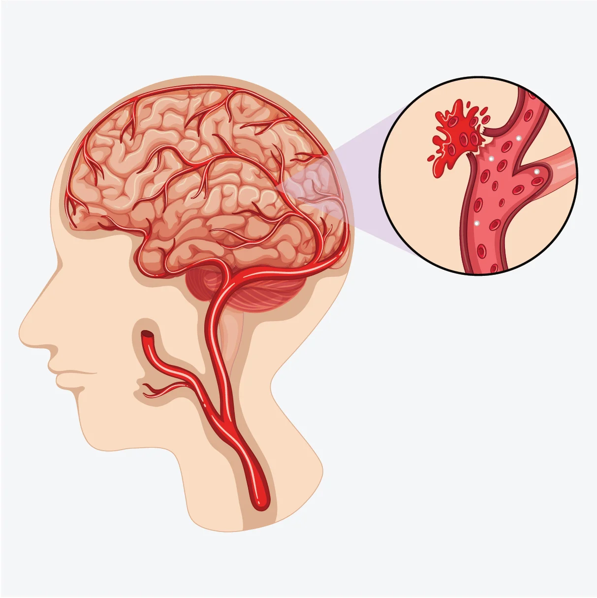 Hemorrhagic Stroke: What You Need to Know 